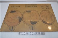 藏品(雙胞胎胎位教學示意圖)的圖片