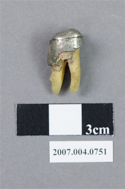 牙科臼齒齒模 (共6張)