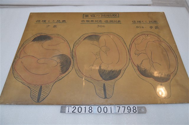 雙胞胎胎位教學示意圖 (共1張)